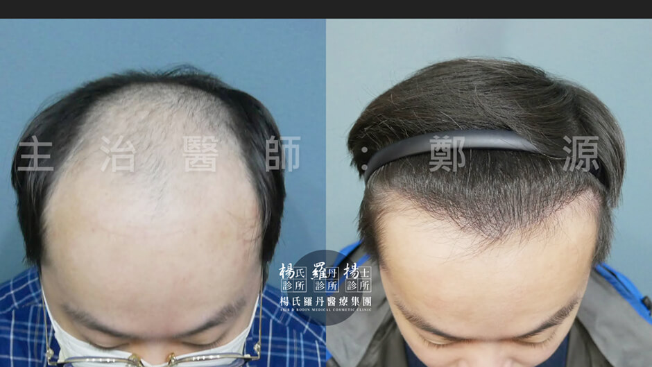 微創植髮 植髮 植髮成果